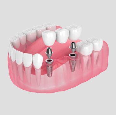 Read about Why Dental Bridges: Blog by Orange Grove Dental