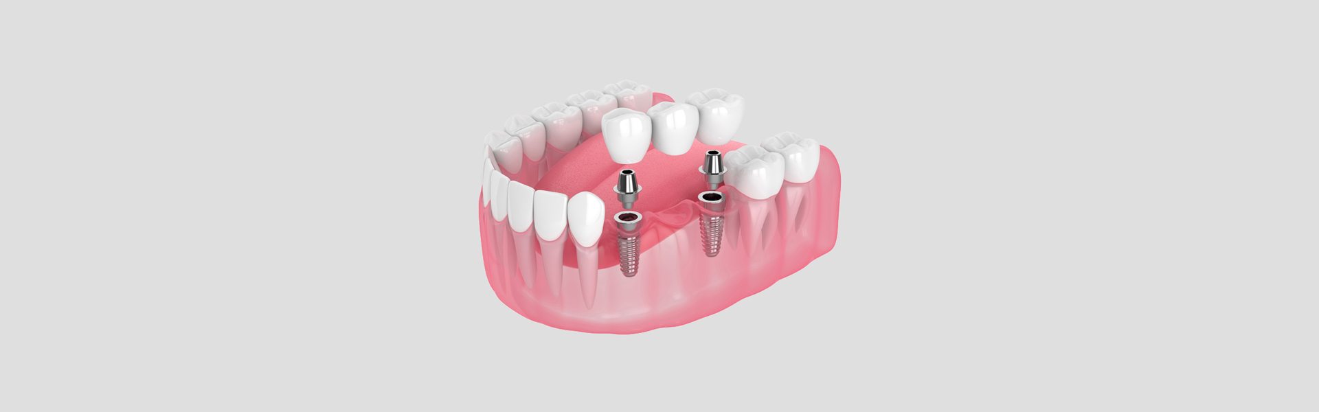 Bridging the Gap: Why Dental Bridges Matter for Oral Health