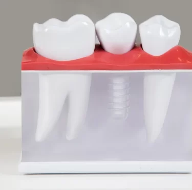 Dental Implants in New Port Richey: Everything You Need to Know